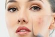 Comment agit la lumière anti-imperfection contre l’acné ?